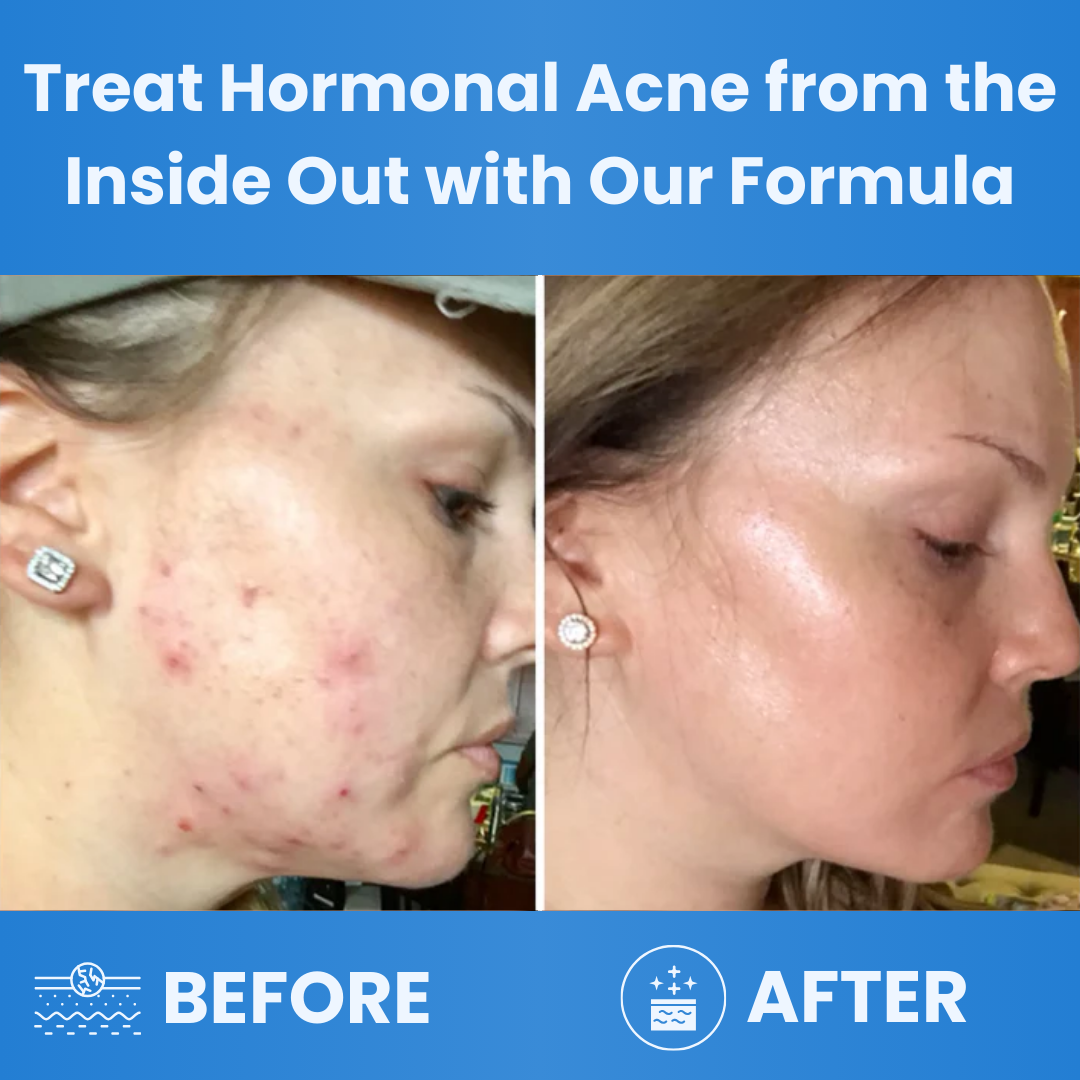 Celisse™ Hormonal Acne Supplement